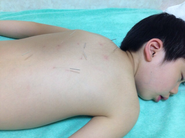 息子の小学二年生が鍼治療を初体験